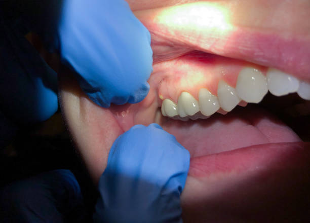 Best Emergency Tooth Extraction in St James, NC